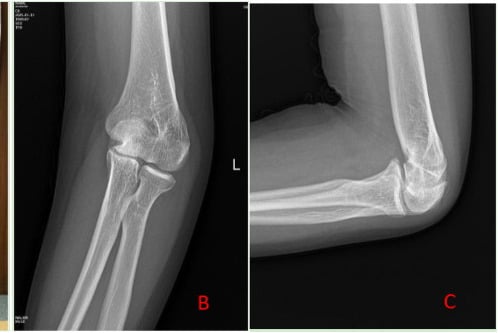 AP and lateral radiographs of established cubitus varus malunion after supracondylar fracture