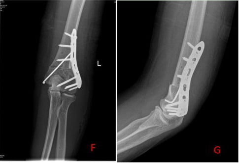 Postoperative AP and lateral radiographs after multiplanar corrective distal humeral osteotomy