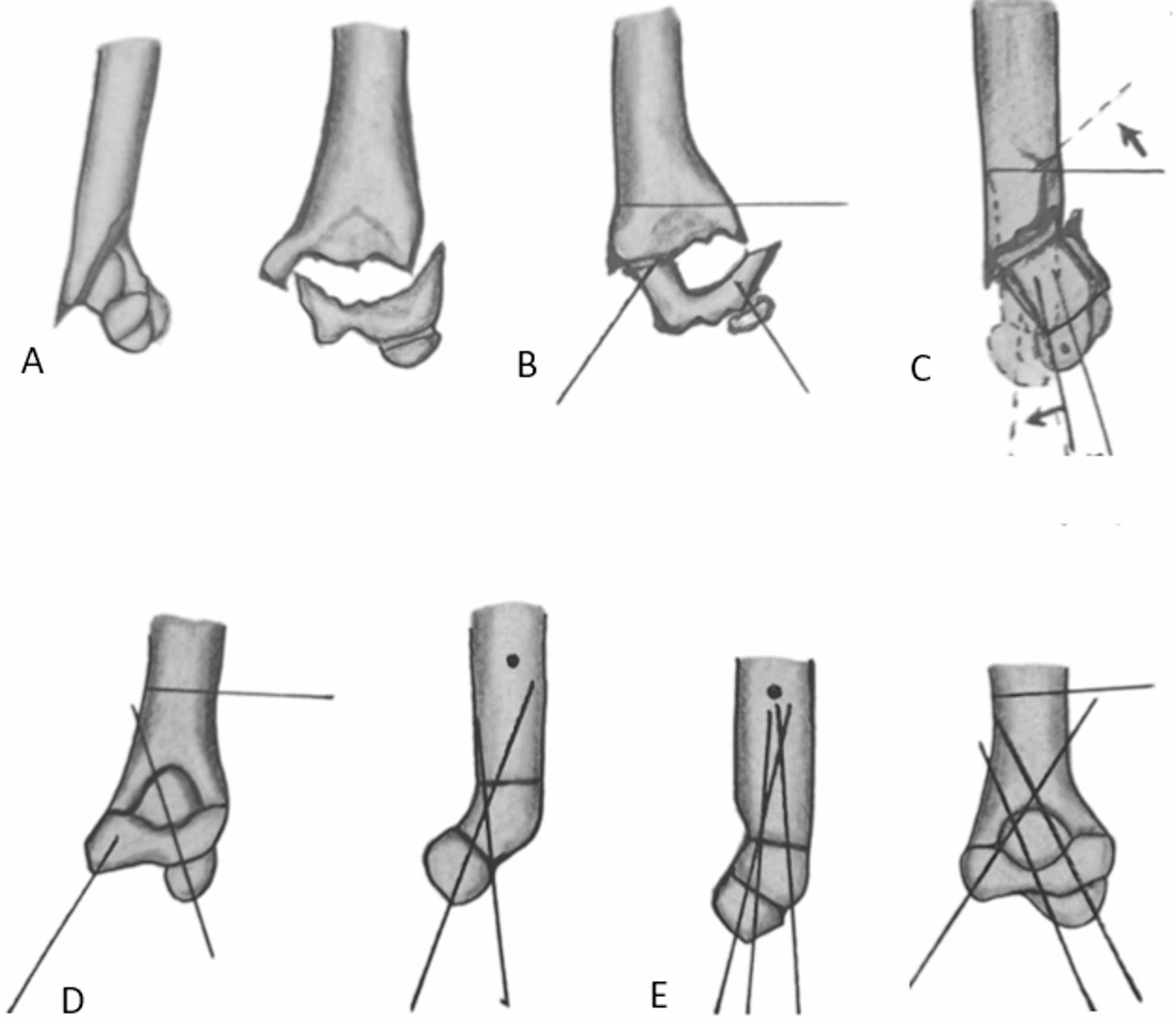 Schematic sequence of a three-wire reduction technique for an irreducible extension-type supracondylar fracture
