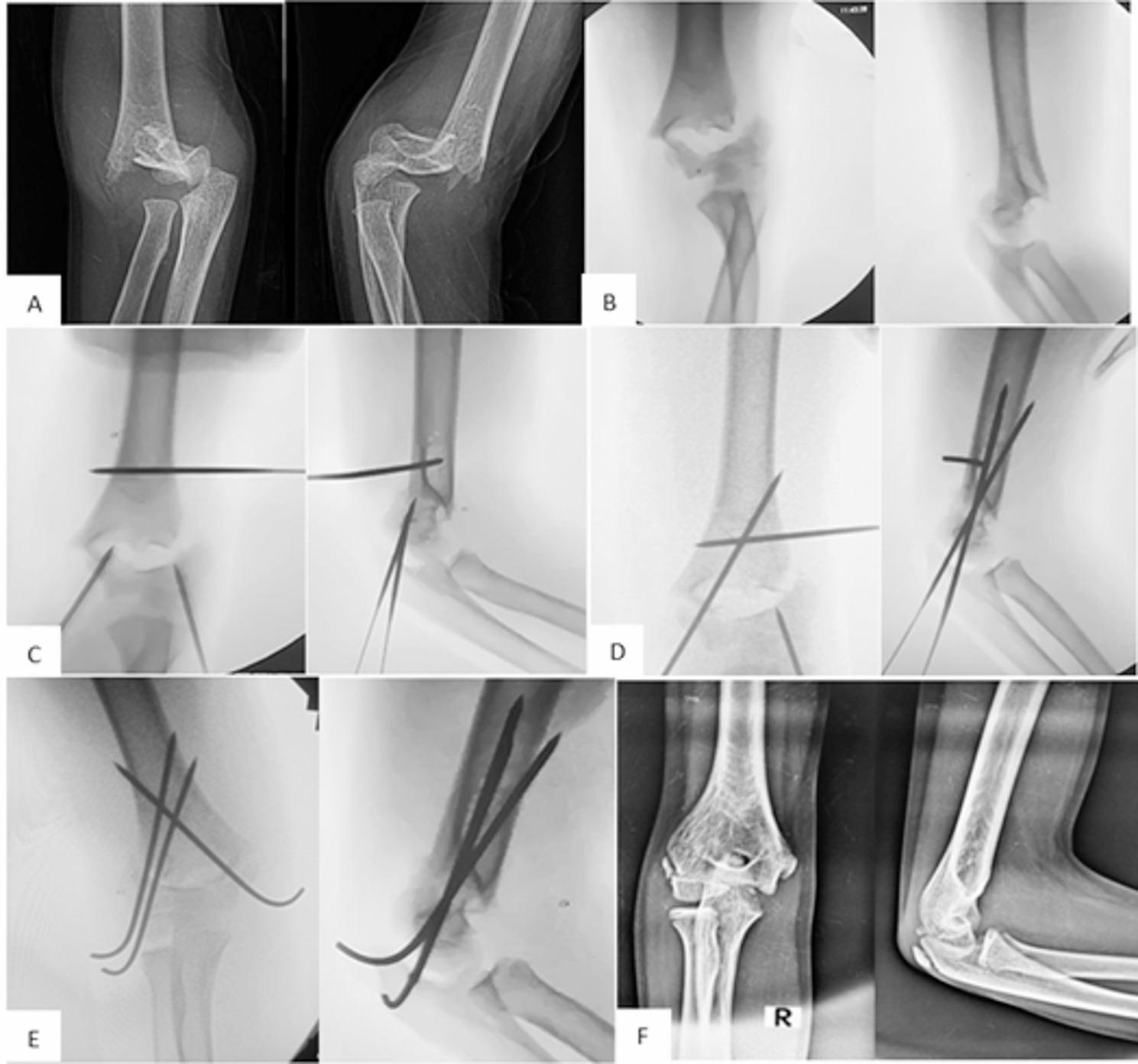 Radiographic and fluoroscopic sequence of wire-assisted reduction and fixation of an irreducible supracondylar fracture