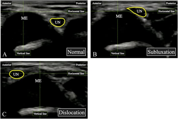 Short-axis ultrasound at the medial epicondyle showing normal, subluxating and dislocated ulnar nerve positions