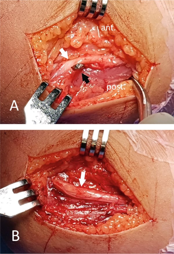 Operative images showing an ulnar nerve tented over a medial K-wire and after decompression