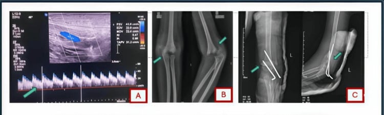 Duplex ultrasound and pre-reduction and post-fixation radiographs from a pink pulseless supracondylar fracture