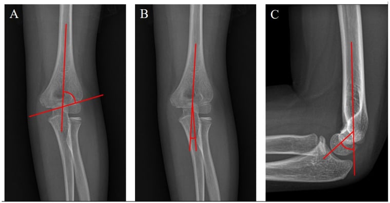 Paediatric elbow radiographs demonstrating Baumann, ulnohumeral and humerocapitellar angle measurements