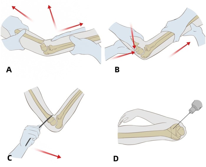 Illustrated sequence of traction, manual reduction, K-wire joystick reduction and fixation