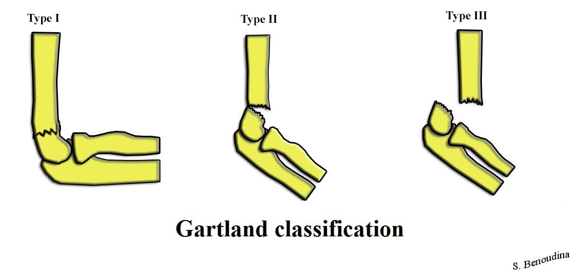 Gartland Classification diagram showing Types I, II, and III supracondylar fractures