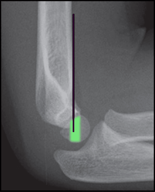 Lateral elbow radiograph demonstrating the anterior humeral line passing through the capitellum