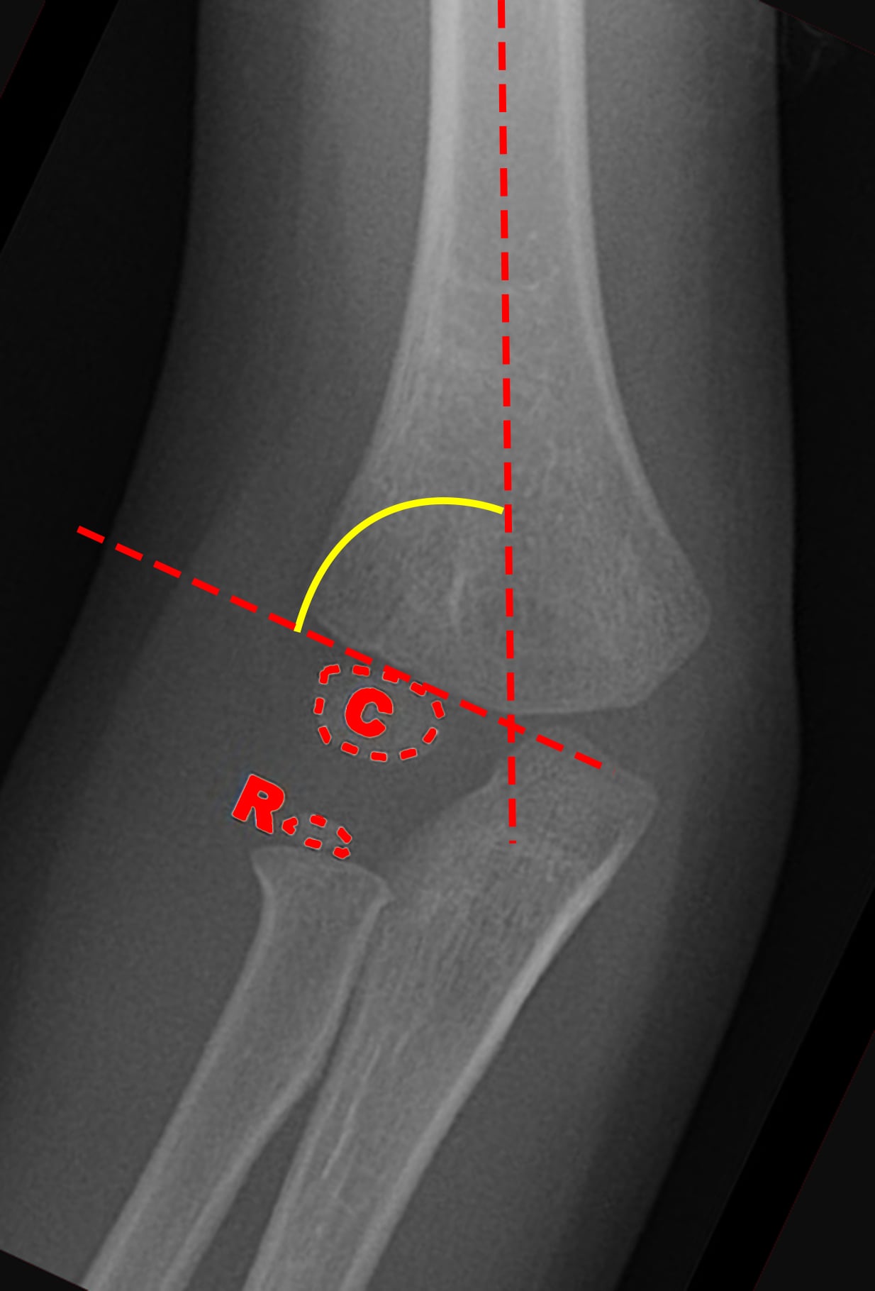 Elbow radiograph demonstrating Baumann's angle measurement