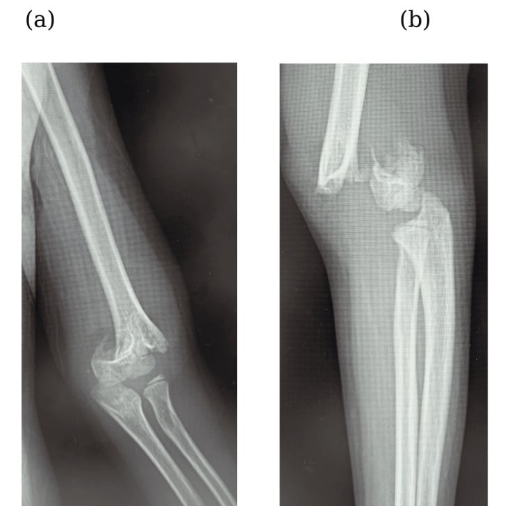 Two radiographs, panels a and b, of a completely displaced paediatric supracondylar humerus fracture