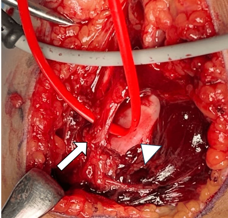 Operative view of the proximal humeral fragment compressing the brachial artery