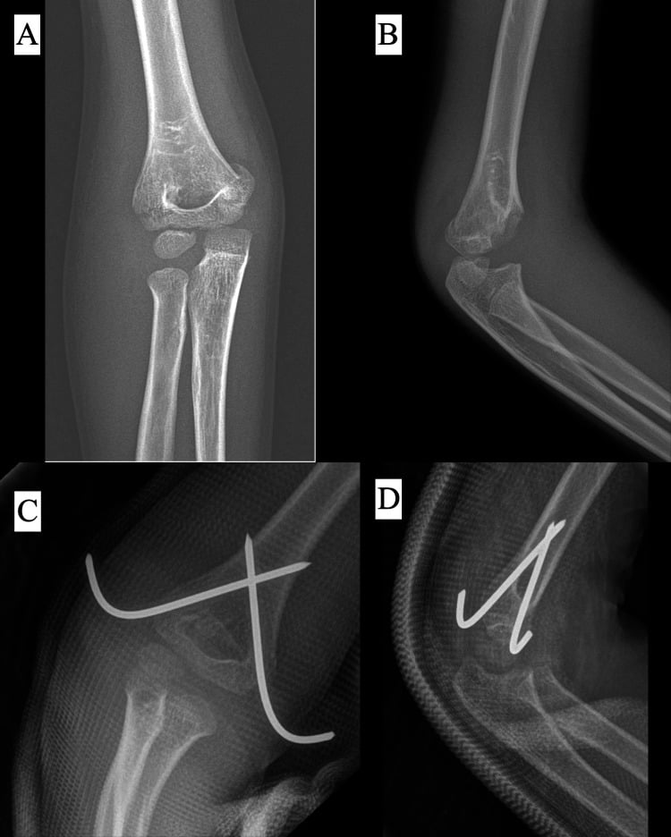 Preoperative and postoperative radiographs of a Gartland type II supracondylar fracture treated with crossed pins
