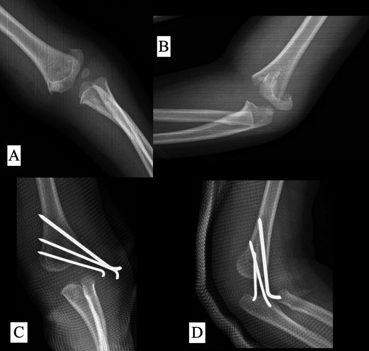 Preoperative and postoperative radiographs of a Gartland type III supracondylar fracture treated with three lateral pins