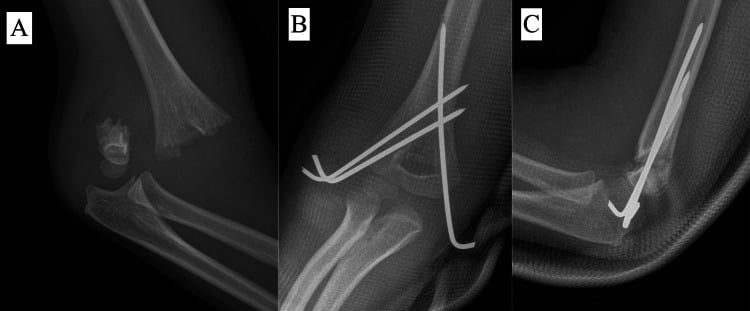 Preoperative radiograph and postoperative pinning radiographs from a Gartland type IV supracondylar fracture case