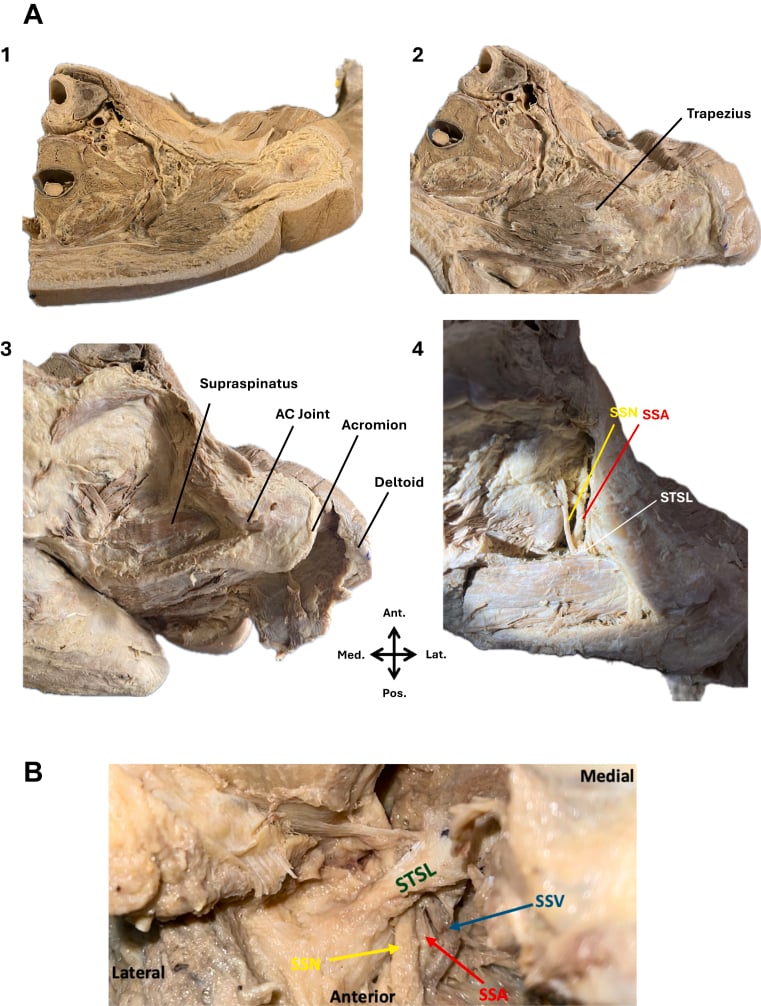 Sequential cadaveric dissection of the superior shoulder showing the suprascapular notch, spinoglenoid region and neighbouring muscles and vessels.