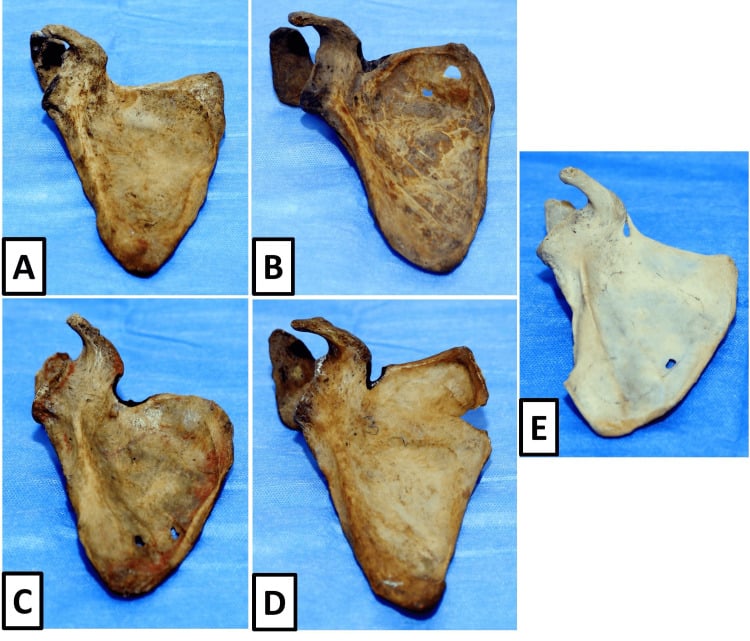 Five dry scapulae demonstrating absent, V-shaped, U-shaped, narrow and ossified suprascapular notch variants.