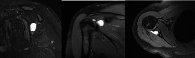 Multiplanar shoulder MRI showing a fluid-signal paralabral ganglion cyst at the spinoglenoid region.
