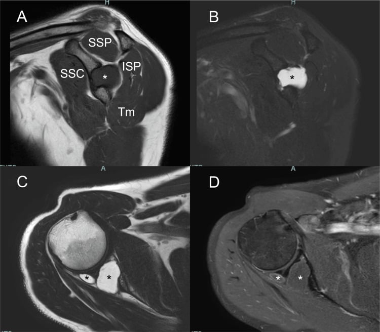 Sagittal and axial contrast-enhanced shoulder MRI showing an intraosseous cystic lesion extending toward the spinoglenoid notch.
