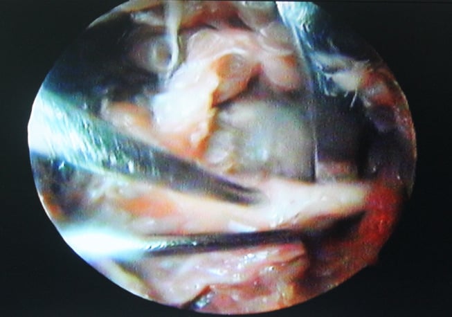Arthroscopic view of suprascapular nerve decompression with ligament release at the notch.