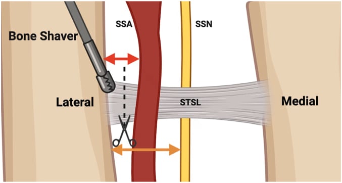 Schematic of ligament division and lateral notch shaving with the suprascapular nerve and artery at risk.
