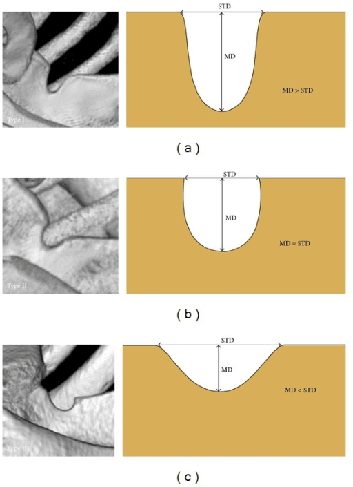 Suprascapular notch morphology types compared by depth and width