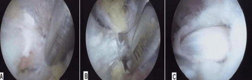 Three arthroscopic views showing division of an ossified superior transverse scapular ligament and nerve decompression