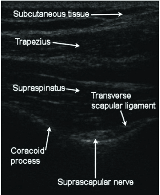 Labelled ultrasound of the suprascapular fossa used for nerve block and assessment