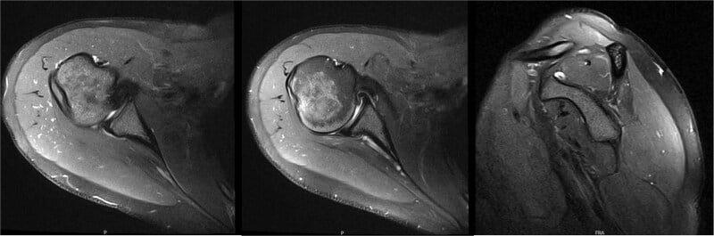 Serial shoulder MRI showing persistent infraspinatus atrophy and fatty infiltration after decompression
