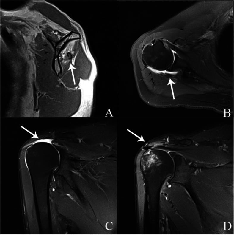 MRI panels showing infraspinatus fatty infiltration, cuff retraction, massive tear and postoperative healing