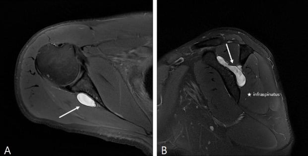 Axial and sagittal T2 MRI showing a large cystic lesion and infraspinatus denervation