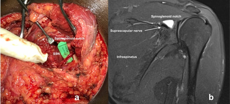 Open operative and MRI views of the decompressed suprascapular nerve at the spinoglenoid notch