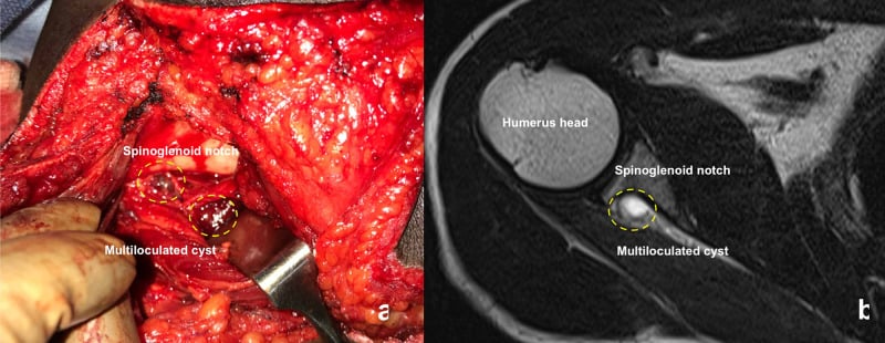 Open operative and MRI views of a multiloculated spinoglenoid notch ganglion cyst