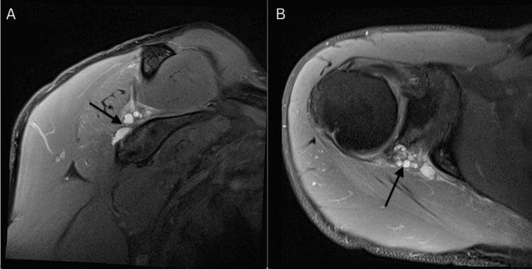 Coronal and axial MRI showing marked reduction of a paralabral cyst after aspiration