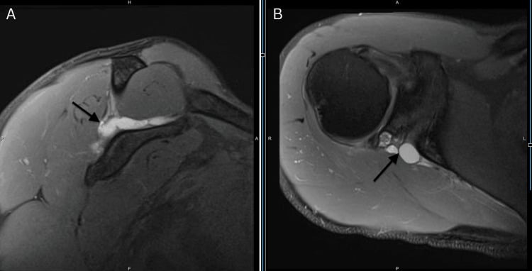 Coronal and axial MRI showing a paralabral cyst before ultrasound-guided aspiration