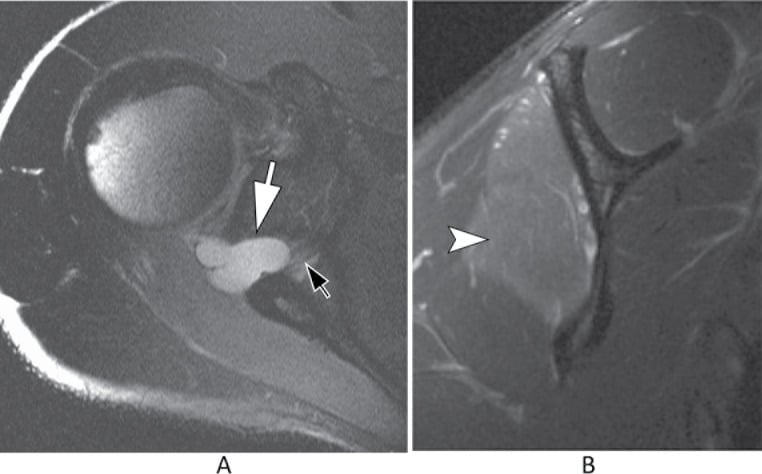 Axial and sagittal T2 MRI showing a spinoglenoid paralabral cyst and infraspinatus denervation oedema