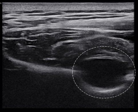 Ultrasound showing a hypoechoic cystic lesion beside the suprascapular notch