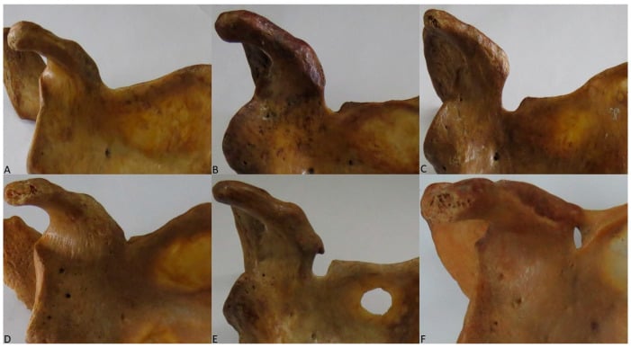 Six cadaveric scapulae showing Rengachary suprascapular-notch types I through VI