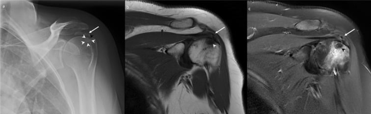AP radiograph and coronal CT of a 2 cm amorphous calcification in the left supraspinatus near the greater tuberosity