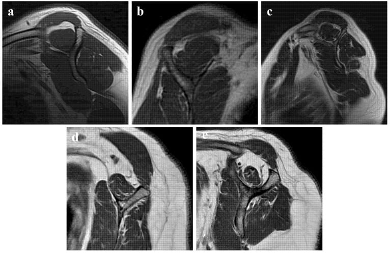 Five sagittal MRI panels of supraspinatus fatty infiltration from Goutallier 0 to 4