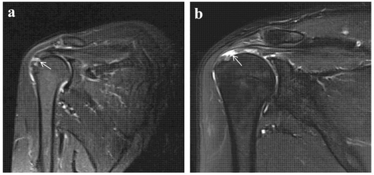 Paired coronal MRI of a traumatic supraspinatus tear with tuberosity oedema versus a degenerative tear without oedema