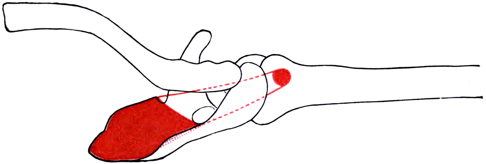 Outline of the right scapula and proximal humerus from above with the supraspinatus origin and insertion marked in red.