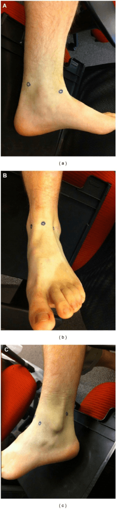 Clinical photographs showing ankle arthroscopy portal positions