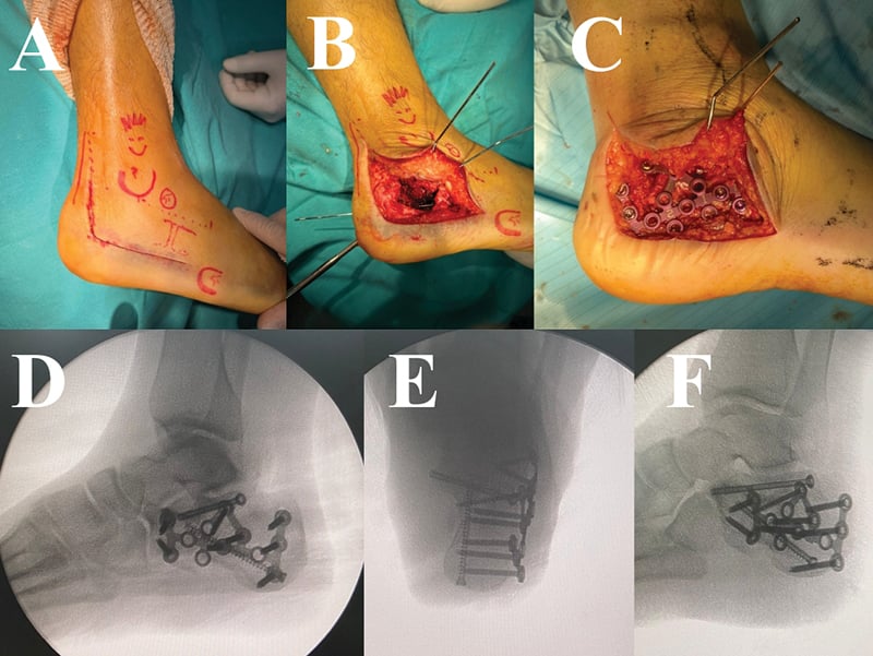 Extensile lateral calcaneus approach with lateral wall plate fixation