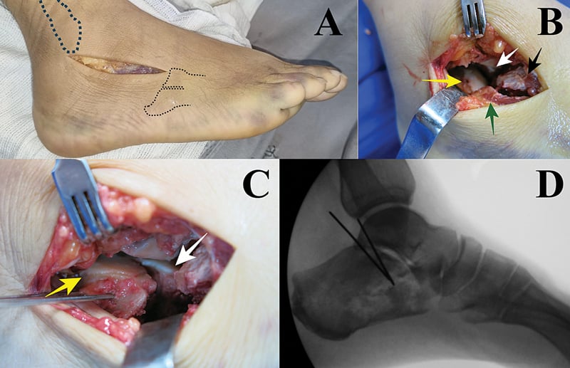 Sinus tarsi calcaneus approach and intraoperative reduction image