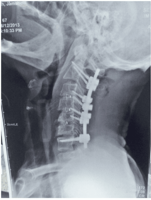 Lateral cervical radiograph showing anterior and posterior cervical constructs