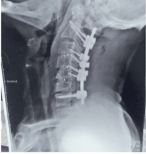 Lateral cervical radiograph of a combined anterior-and-posterior (360-degree) cervical fusion construct.