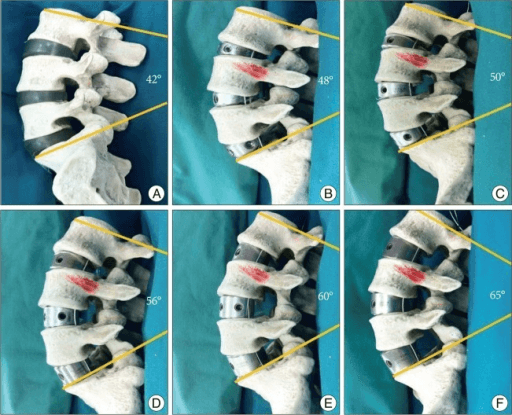 Lumbar model showing lordosis correction with anterior lumbar interbody support