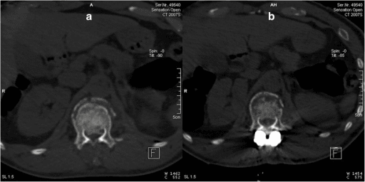 Axial CT images showing thoracolumbar canal fragment before and after reduction