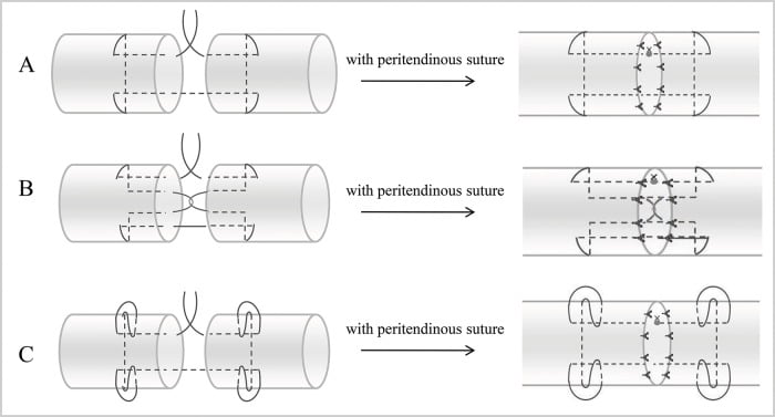 Flexor tendon repair suture technique schematic
