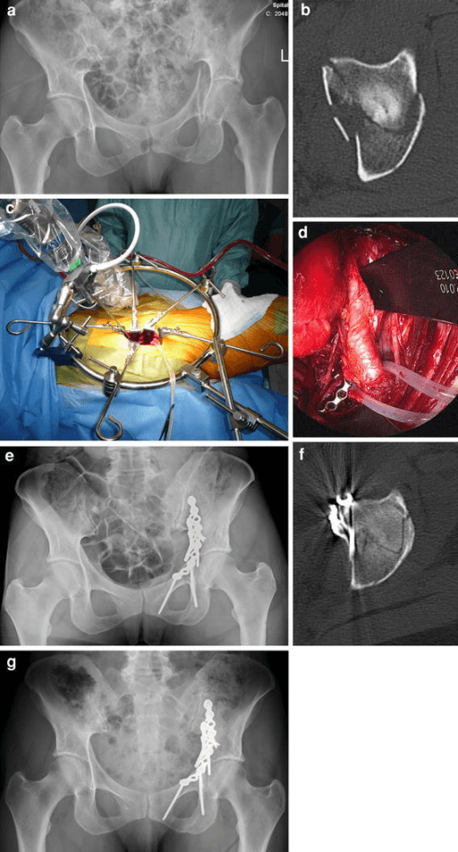 Acetabular fracture radiographs, CT images and operative planning sequence