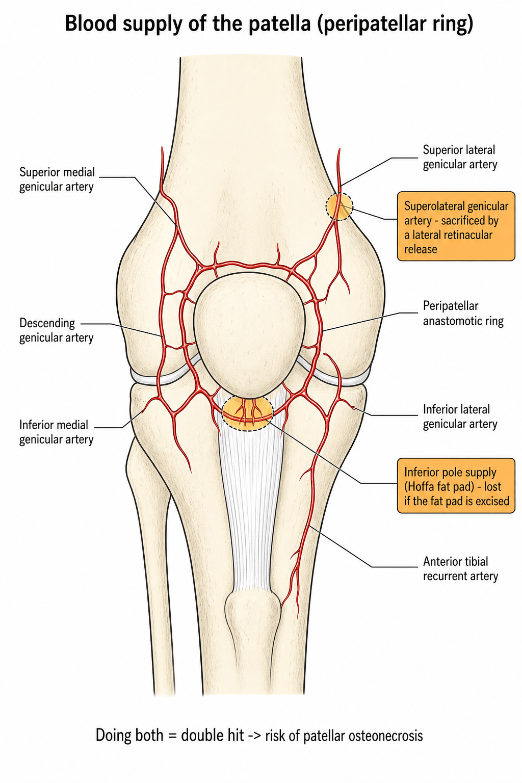 Anterior knee diagram of the peripatellar anastomotic arterial ring and the genicular arteries supplying the patella, with the superolateral genicular and Hoffa-fat-pad vessels highlighted